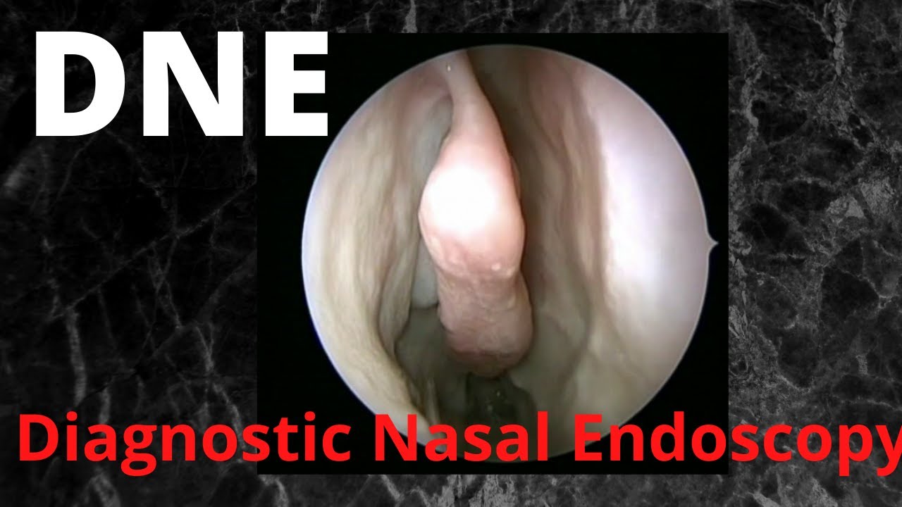 059.Diagnostic Nasal Endoscopy (DNE)  #fess    #nosejob