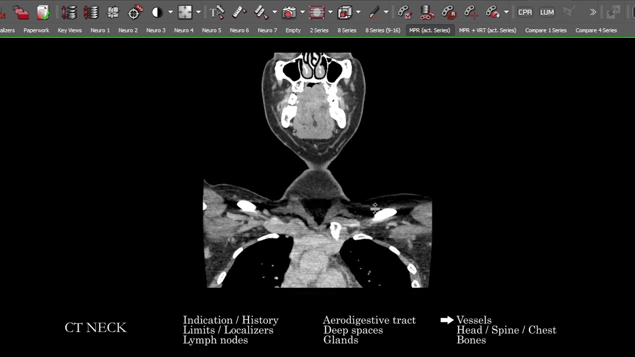[CT] Neck | Search Pattern