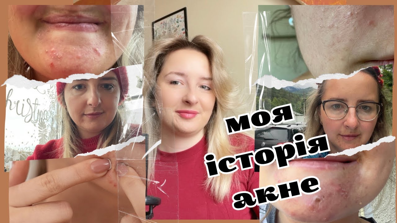 6 РОКІВ ПОМИЛОК, АНАЛІЗІВ І ПРАВДИ ПРО АКНЕ