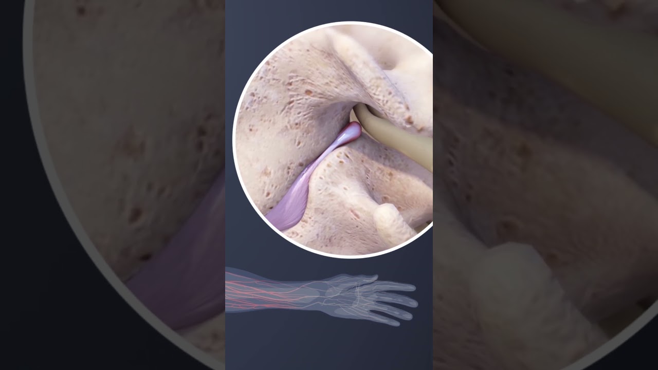 Cervical Radiculopathy