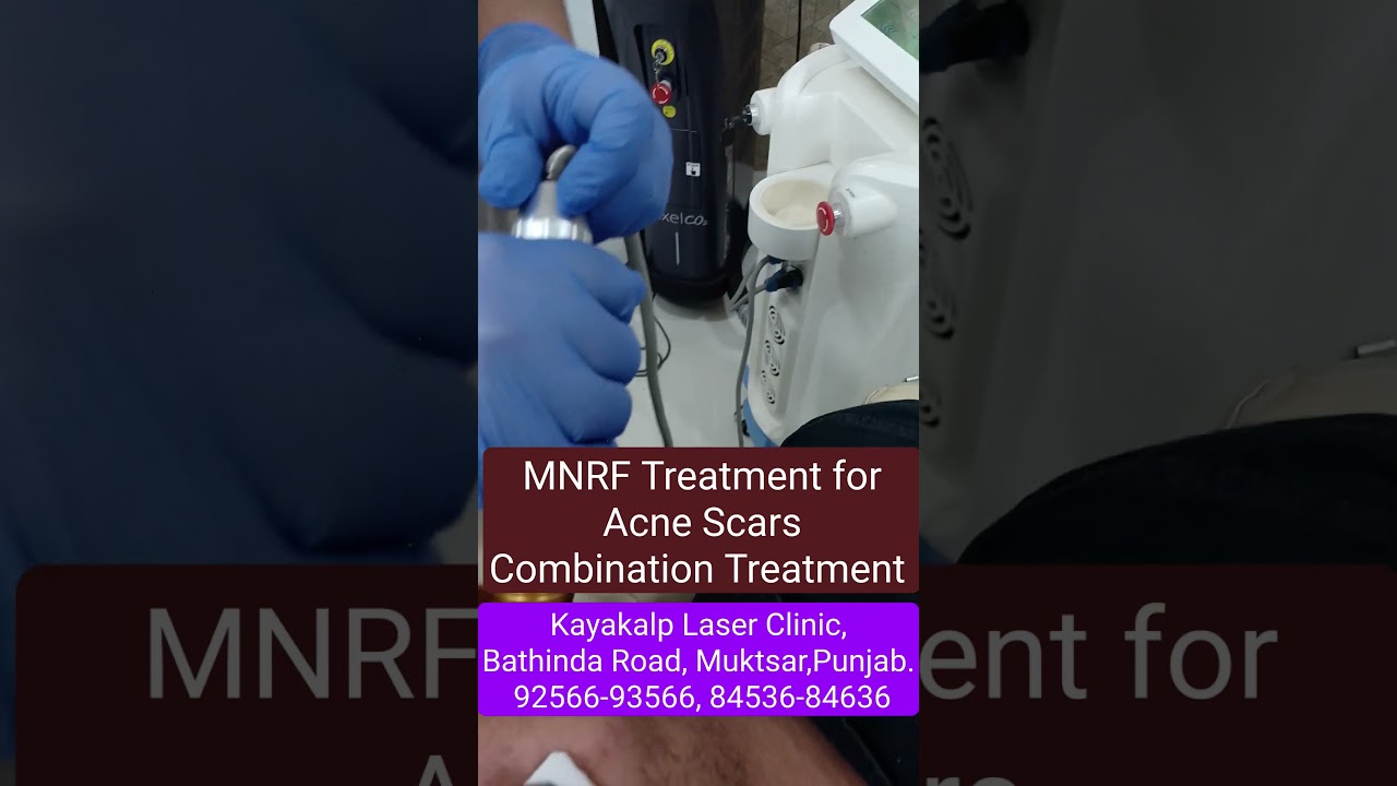 MNRF Treatment for Acne Scars Combination Treatment | Face Scars | Results