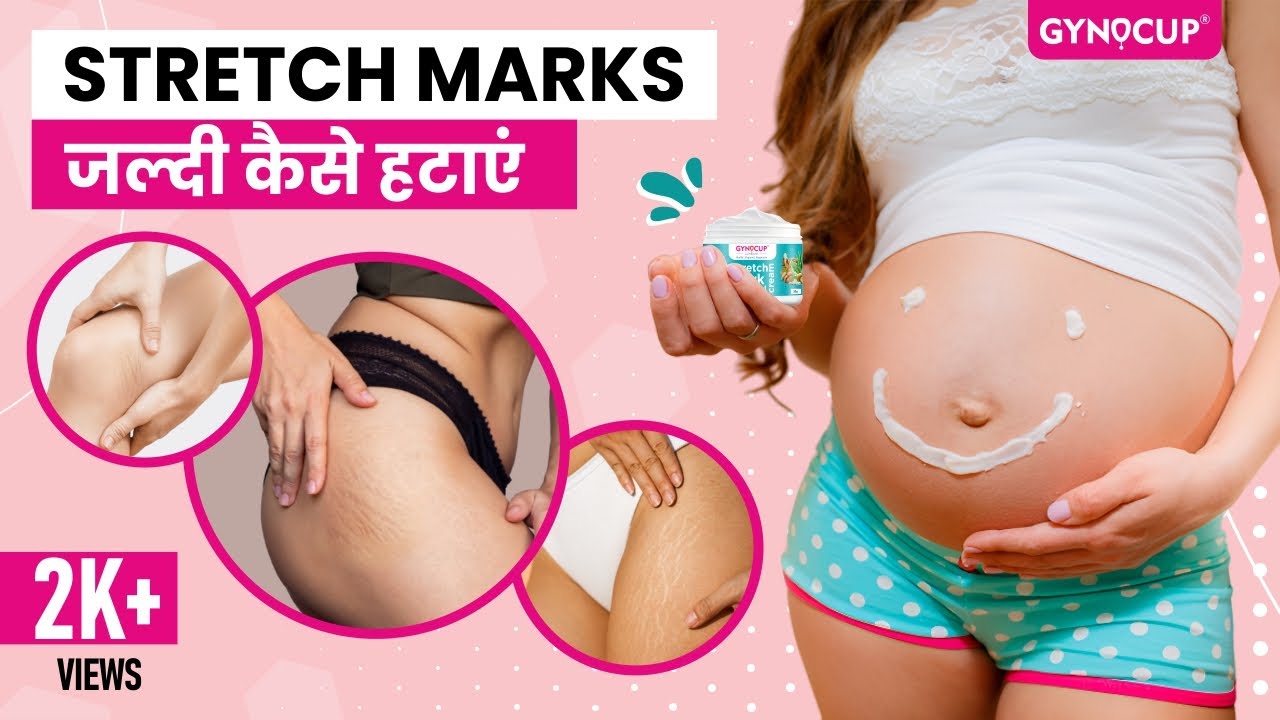 Gynocup stretch mark cream | best stretch cream | stretch mark removal cream || #Gynocup