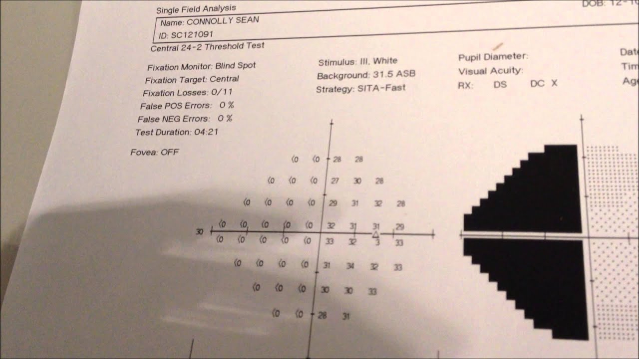 Interpreting Visual Fields