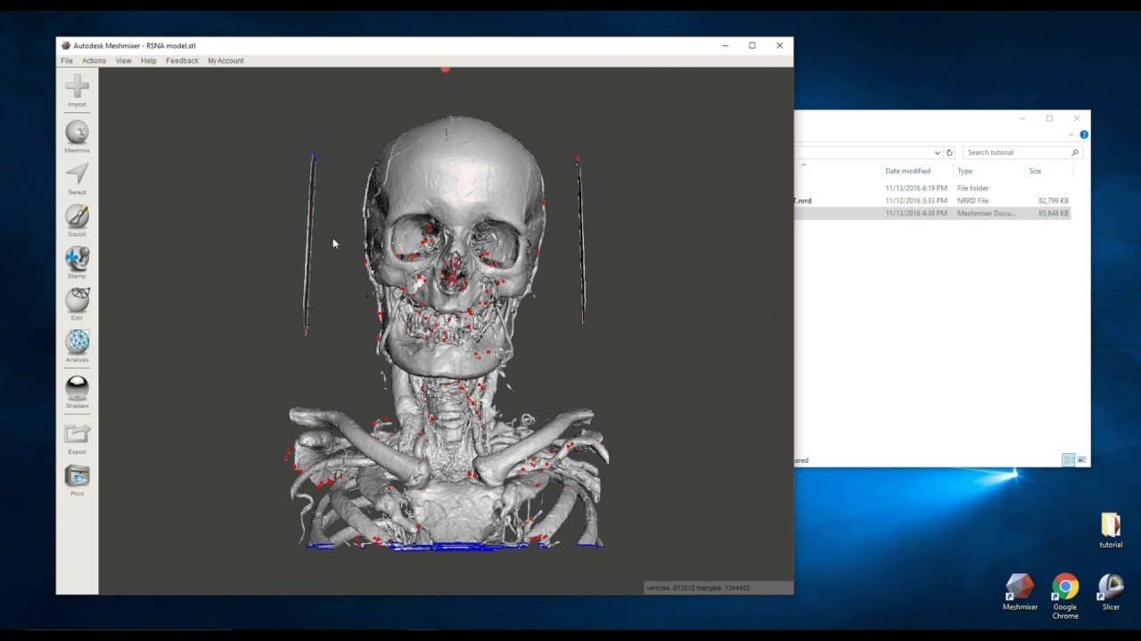 Creating 3D Printable Medical Models for Free: Embodi3D.com, 3D Slicer, and Meshmixer