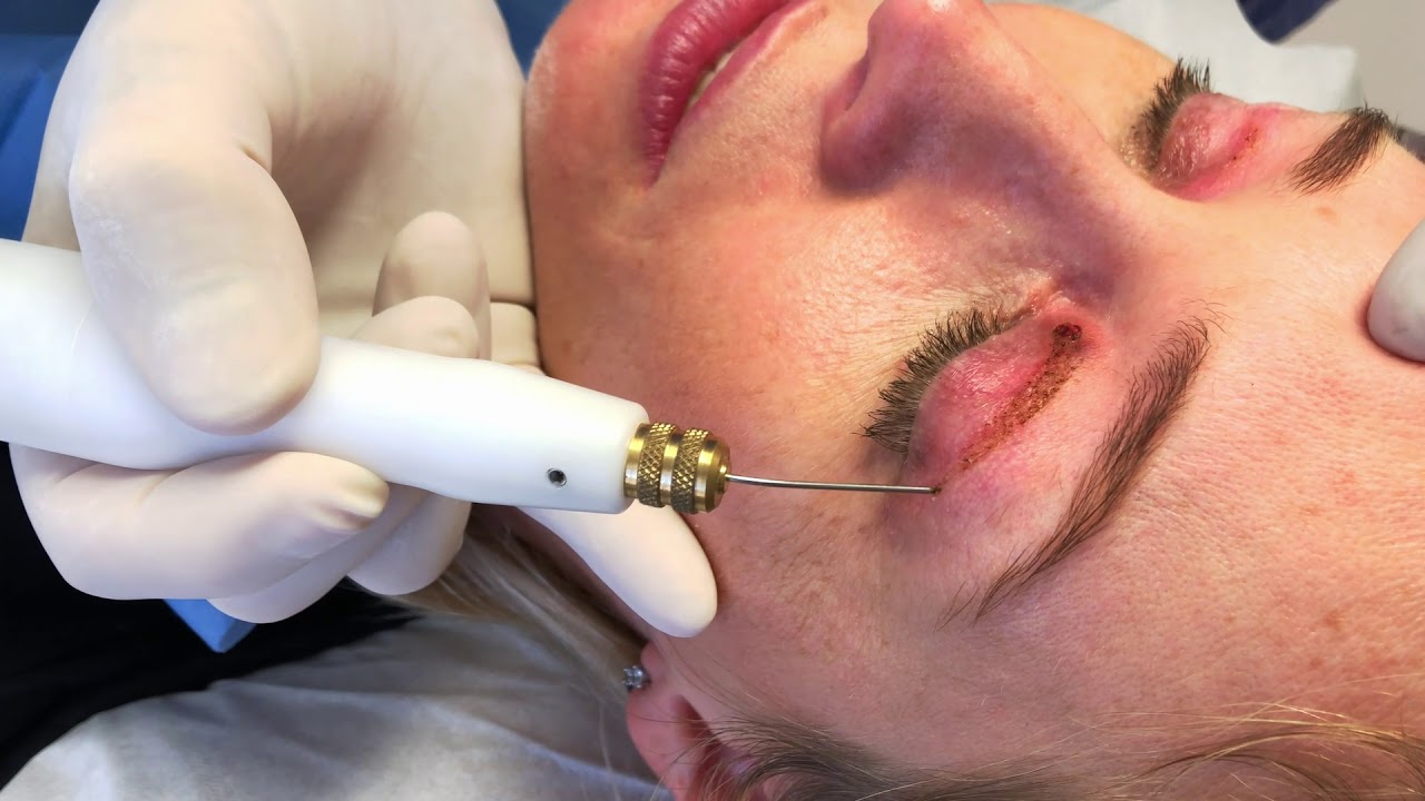 Blépharoplastie médicale - une nouvelle méthode pour rajeunissement sans chirurgie