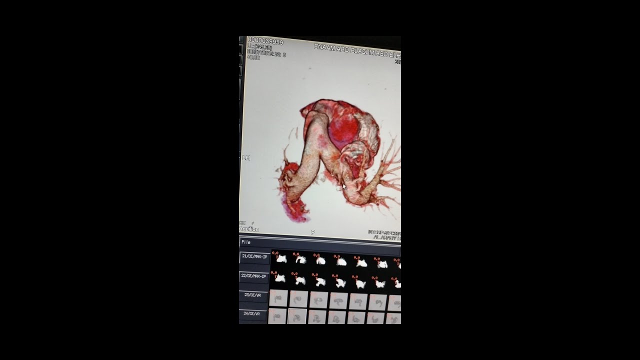 فحص الاشعه المقطعيه علي الشريان الرئوي \ CT Pulmonary Angiography