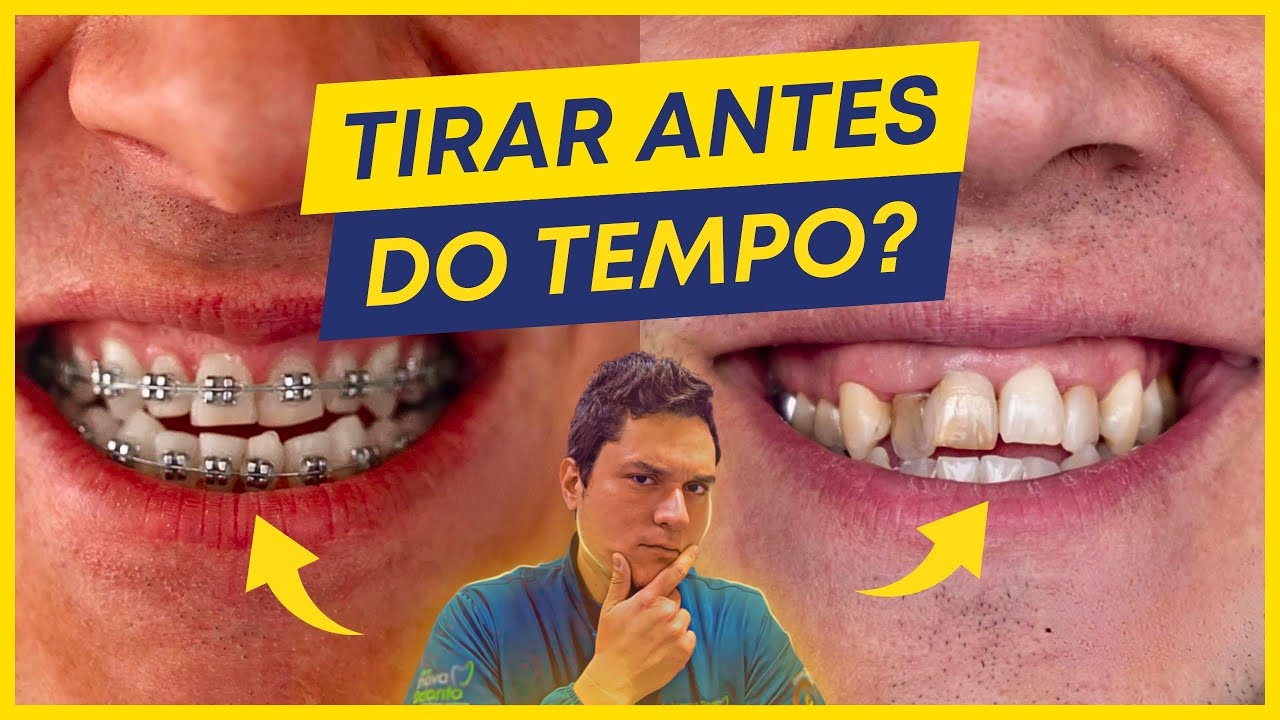 O QUE ACONTECE SE TIRAR O APARELHO ANTES DO TEMPO?