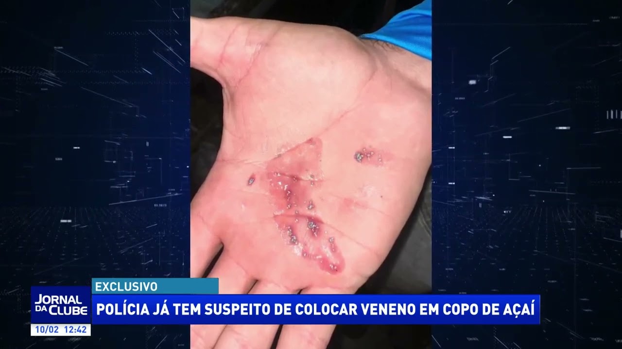 Polícia já tem suspeito de colocar veneno em copo de açaí - Jornal da Clube (10/02/26)