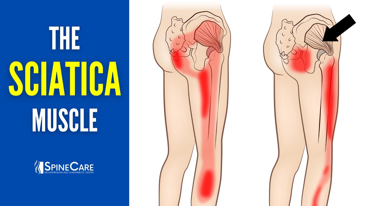Release THIS Muscle and Stop Sciatica Pain Fast