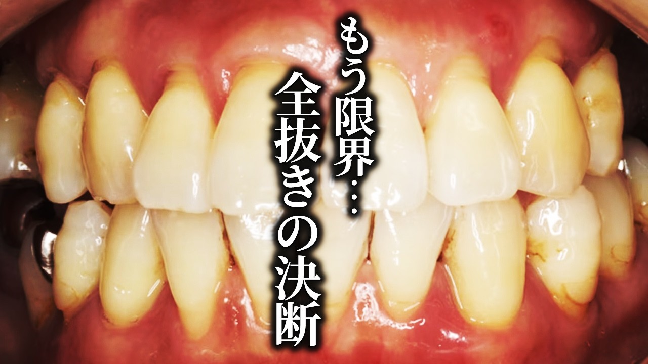 なぜこの歯をすべて抜かなければいけなかったのか