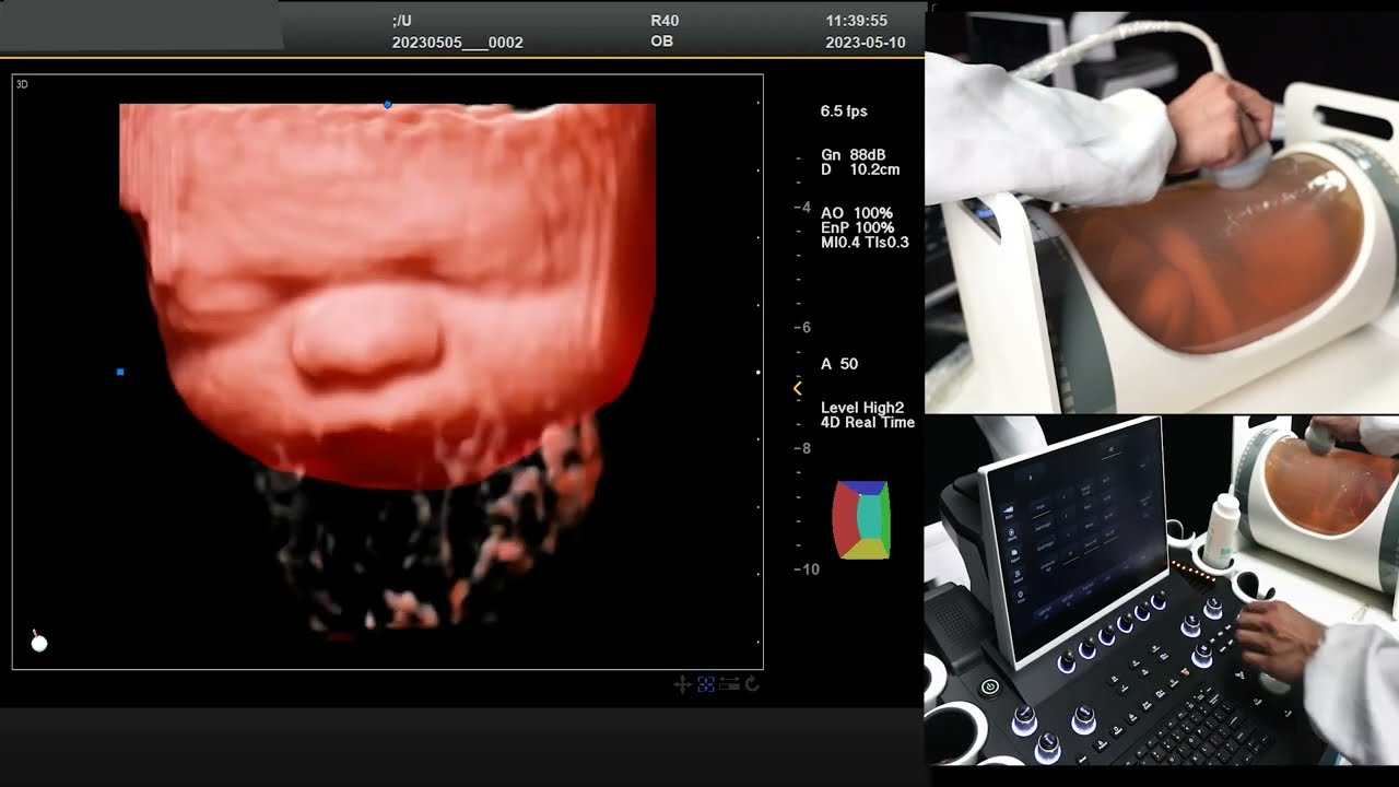 How to get better 3D/4D scan image quality with ultrasound?