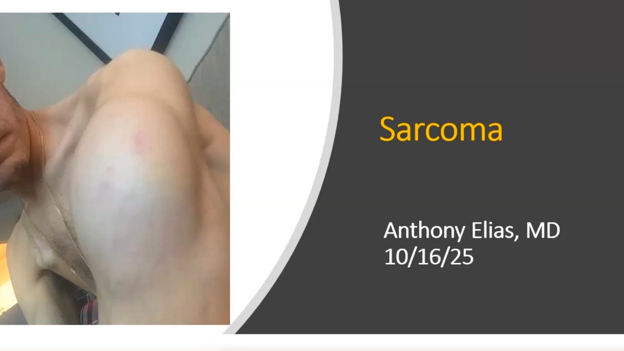 Sarcoma Management CU Cancer Center IITs