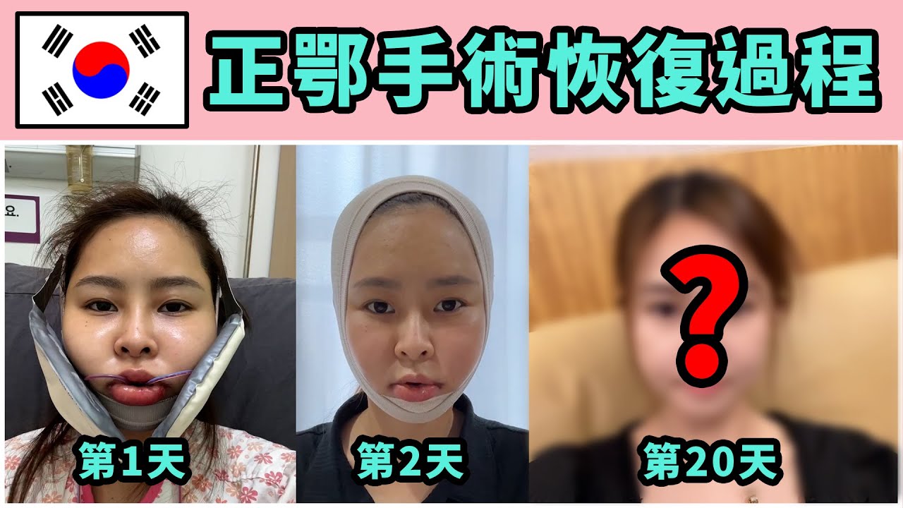 臺灣女生在韓國做正鄂手術第20天了！！（feat,韩国整形医院咨询室长）