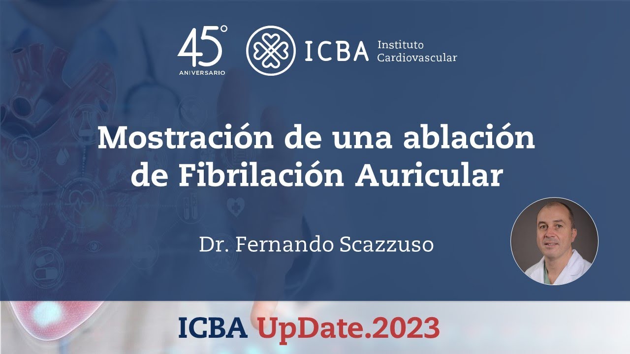 Mostración de una ablación de Fibrilación Auricular - FA