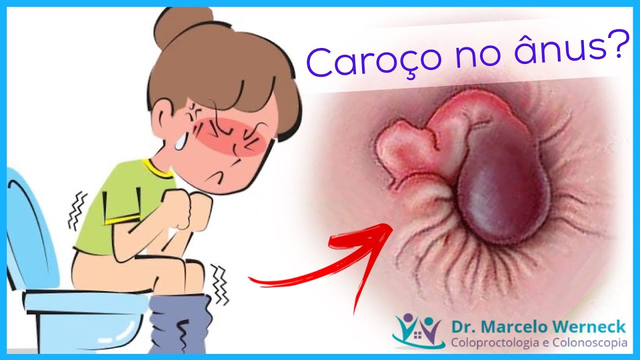 Fiz muita for&ccedil;a pra evacuar e apareceu uma bolinha no &acirc;nus. O que ser&aacute;?