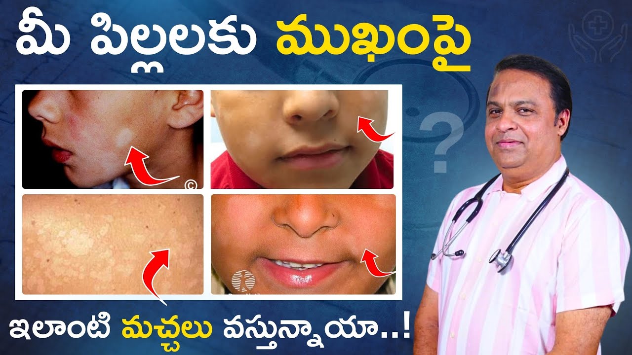పిల్లల ముఖం పై తెల్ల మచ్చలు/white patches on baby face in telugu /white spots on baby face