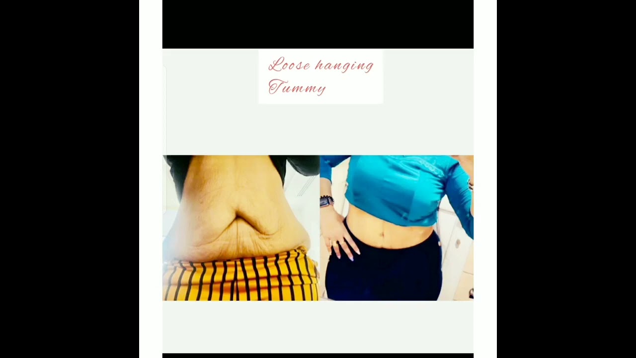 TUMMY TUCK AND BREAST AUGMENTATION BY DR ARIF HUSSAIN
