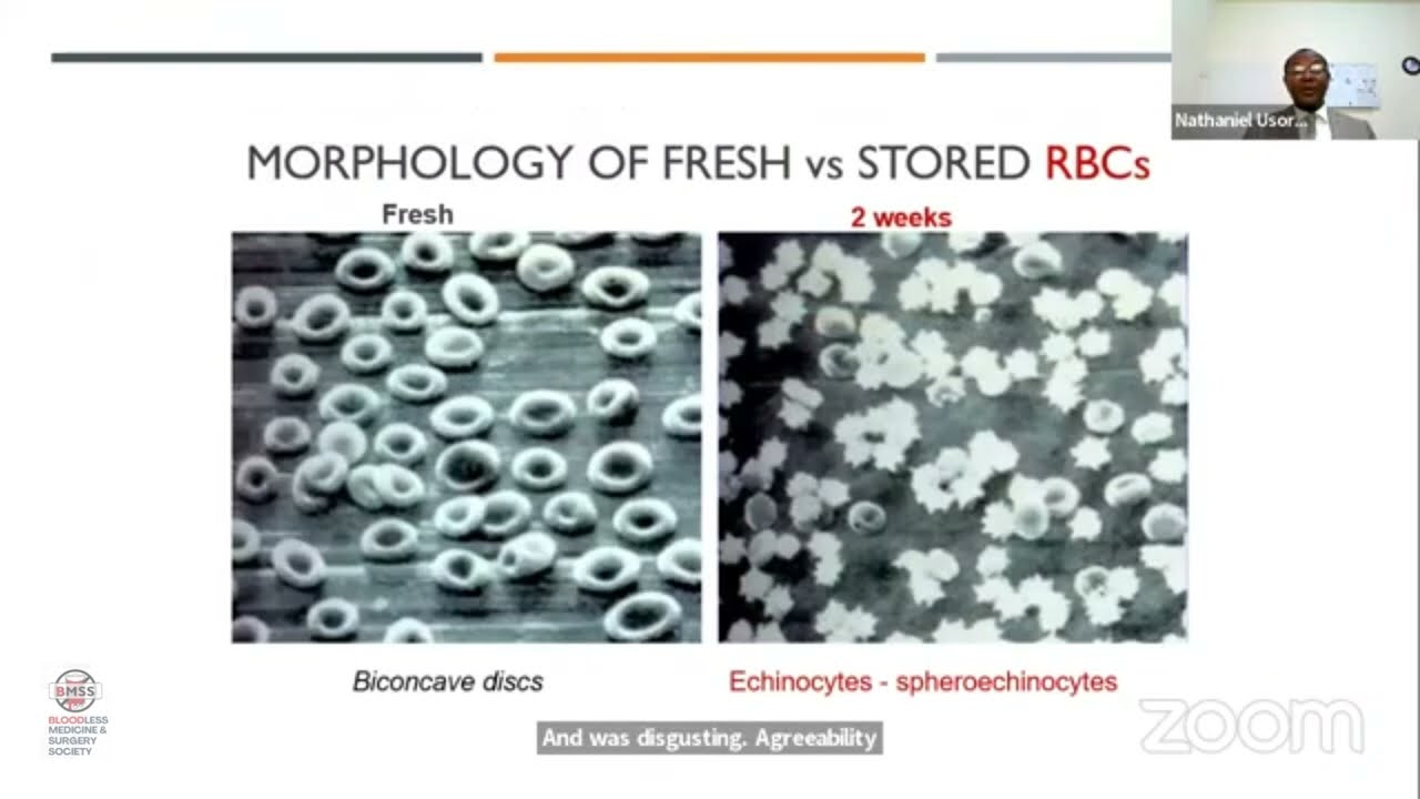 Bloodless breast cancer surgery as the standard of care (Nathaniel Usoro, MD)