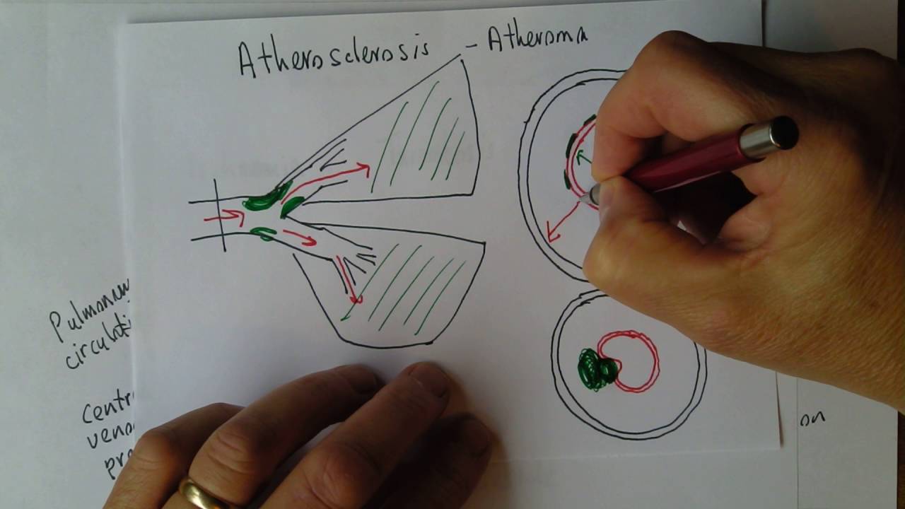 Cardiovascular Diseases 3, Systemic arteries and atherosclerosis