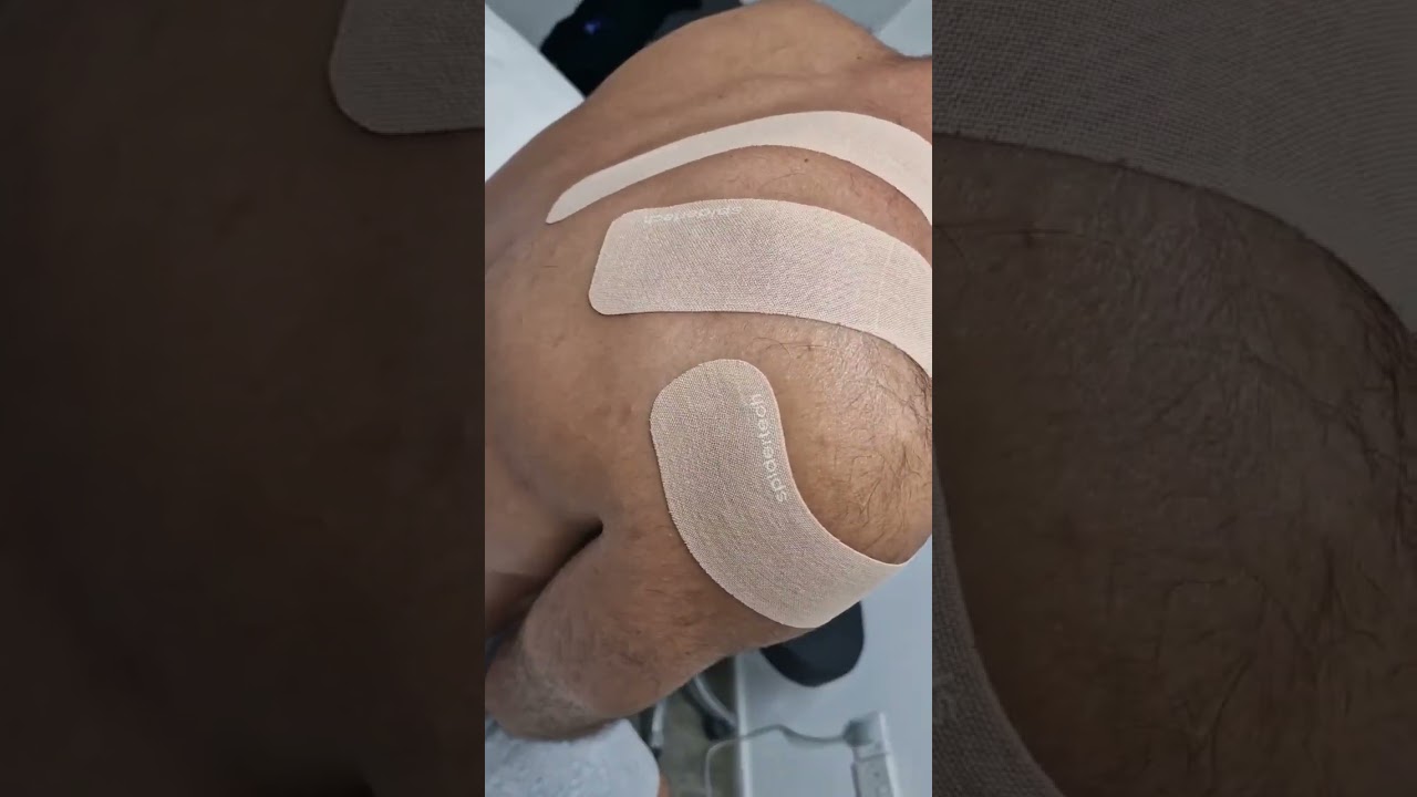 Shoulder taping with our i-Strips