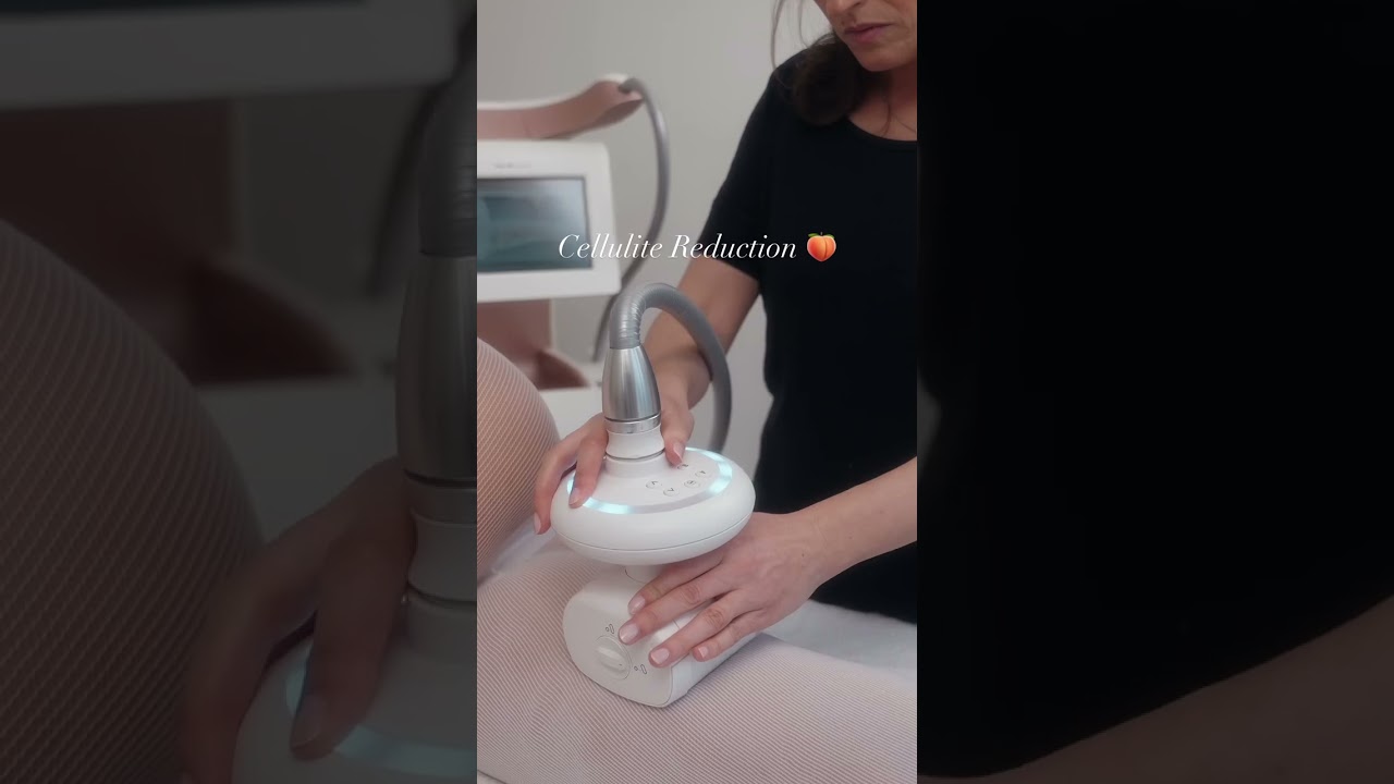 LPG Endermologie The Best Solution for Stubborn Fat & Cellulite
