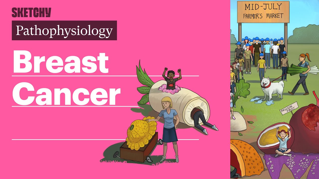 Breast Cancer (Pathophysiology) | Sketchy Medical