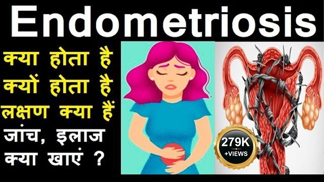What is Endometriosis, in Hindi, Symptoms, Treatment, Diet, Surgery, Occurs, Affects fertility