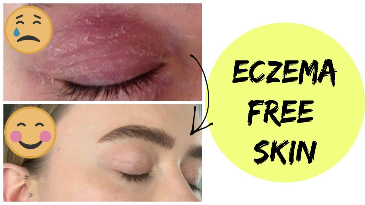 WHAT I EAT FOR CLEAR, ECZEMA FREE SKIN IN A DAY