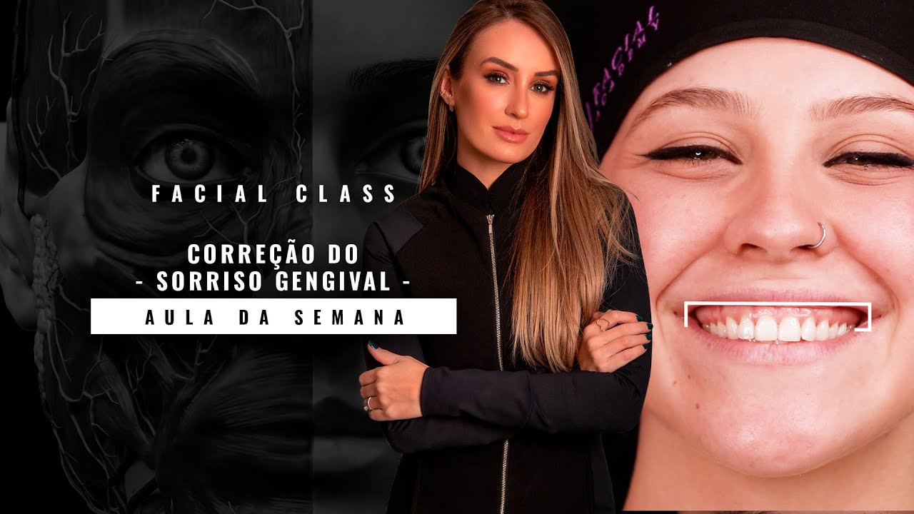 Tratamento de Sorriso Gengival com Toxina Botulínica