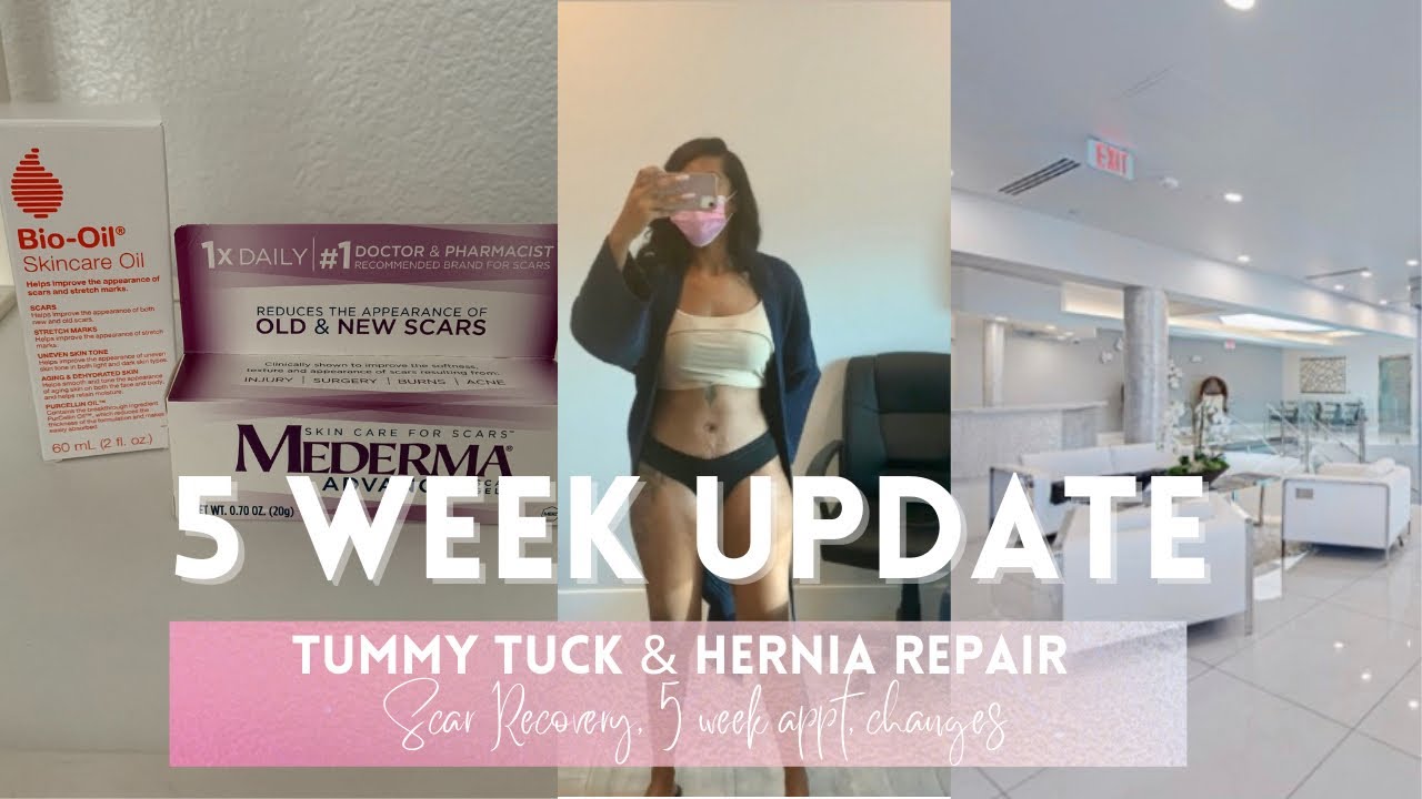 5 week tummy tuck update | Vlog