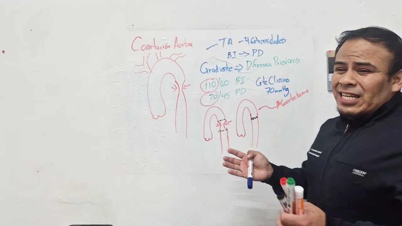 Coartación Aórtica en sala hemodinamia pediátrica 