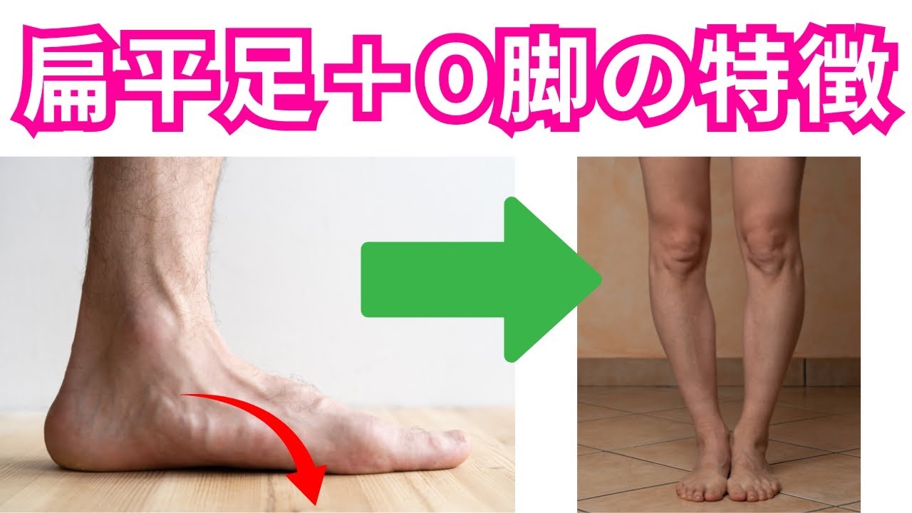 【扁平足でO脚の人の特徴とは？】足のアーチを持ち上げることでO脚は寧ろ悪化する！扁平足とO脚の関係性とセルフケア・エクササイズ方法！【運動療法/ピラティス/O脚】