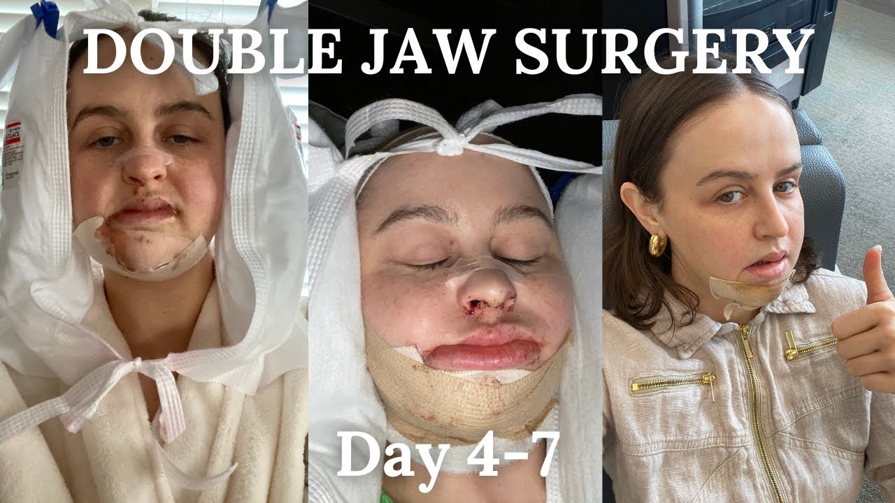 Day 4-7 | Double Jaw Surgery Journey