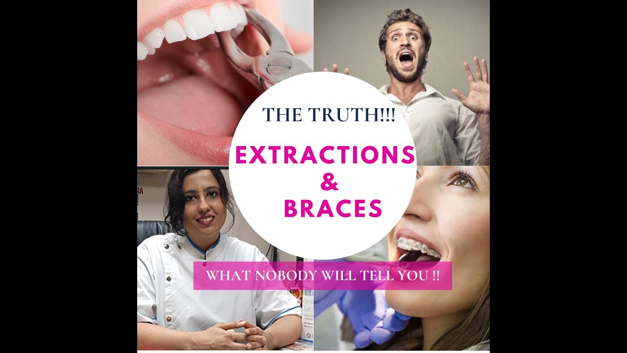 EXTRACTION OF TEETH FOR BRACES | THE TRUTH | IS IT NECESSARY | MUST WATCH| DR SONAHITA BRACES DOCTOR