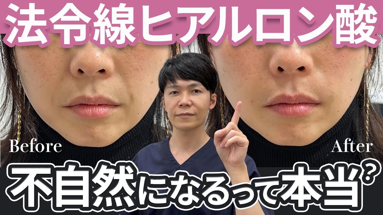顔がパンパンになる？！法令線ヒアルロン酸注射の症例を解説します