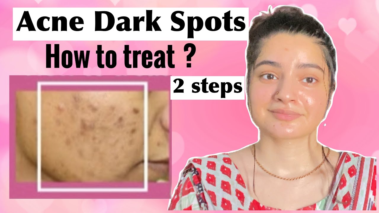 How to REMOVE DARK SPOTS from Face NATURALLY| ACNE SPOTS |
