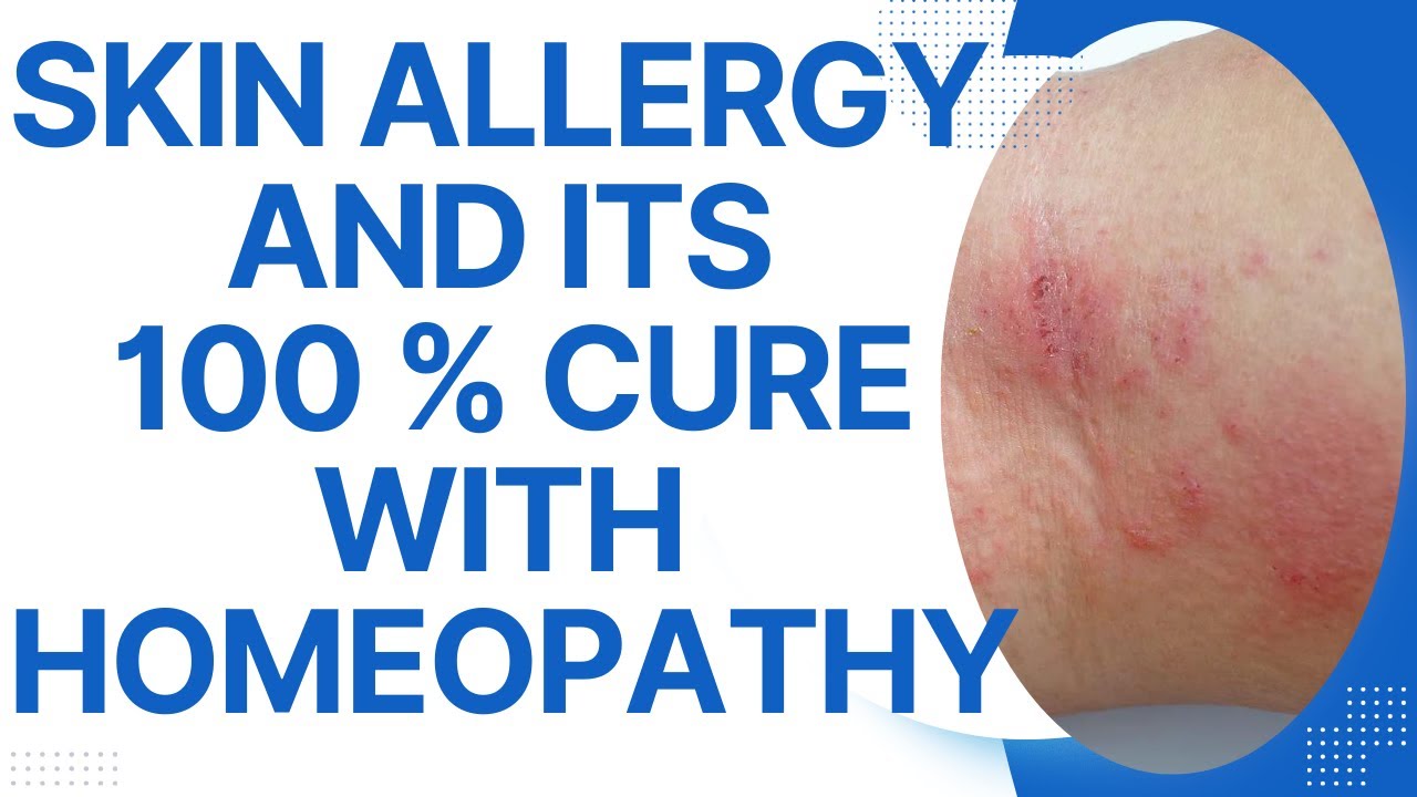 SKIN ALLERGY || BEST HOMEOPATHIC MEDICINE FOR SKIN ALLERGY || HOMEOPATHIC MEDICINE FOR SKIN ALLERGY