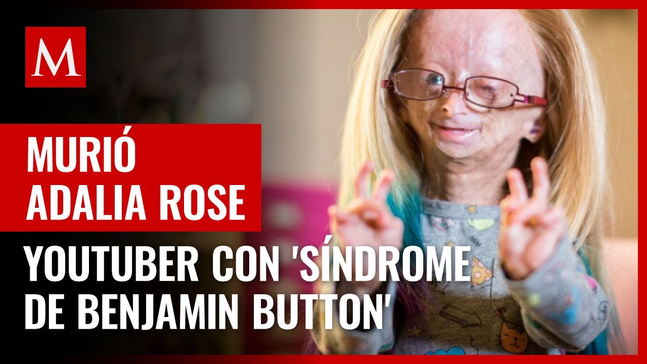 Murió Adalia Rose, youtuber con el 'síndrome de Benjamin Button', a los 15 años
