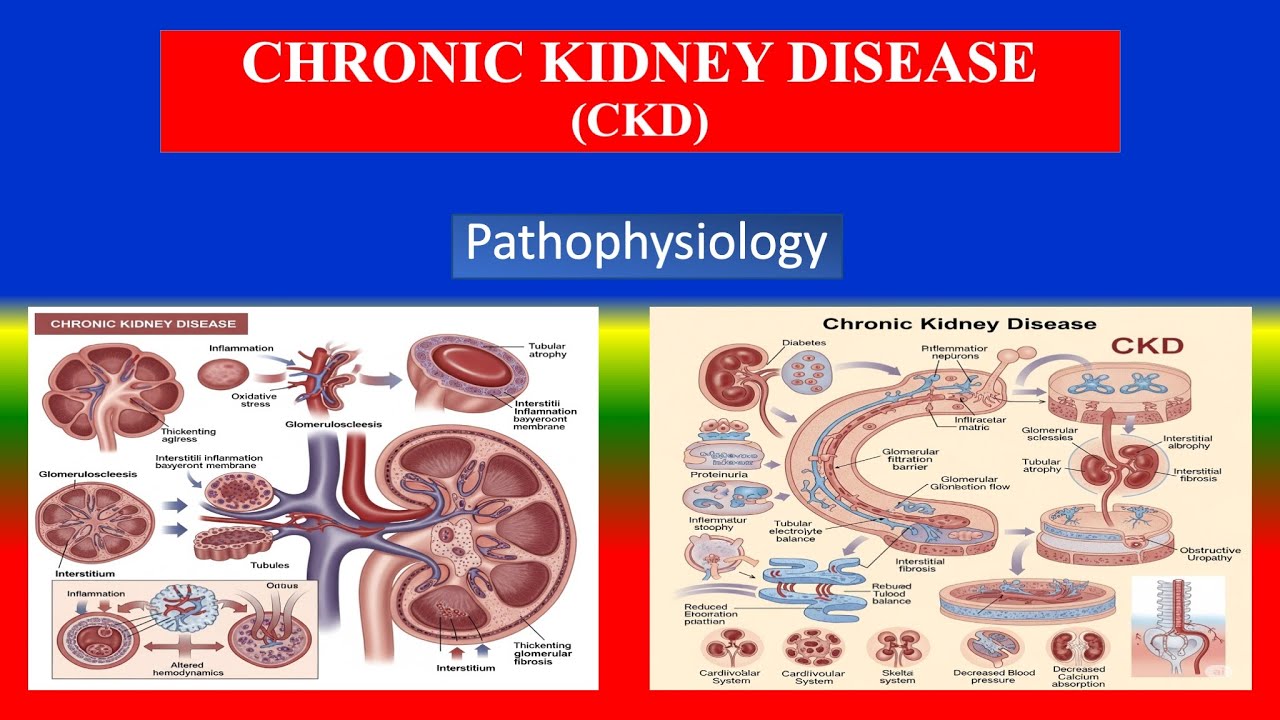 CHRONIC KIDNEY DISEASE (CKD) - Pathophysiology Step By Step Process  - Explained