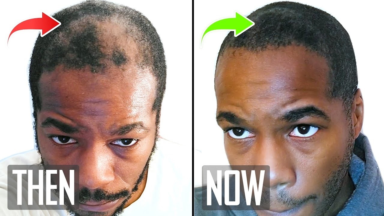 Rosemary Oil for Hair Regrowth - Black Tea as a DHT Blocker