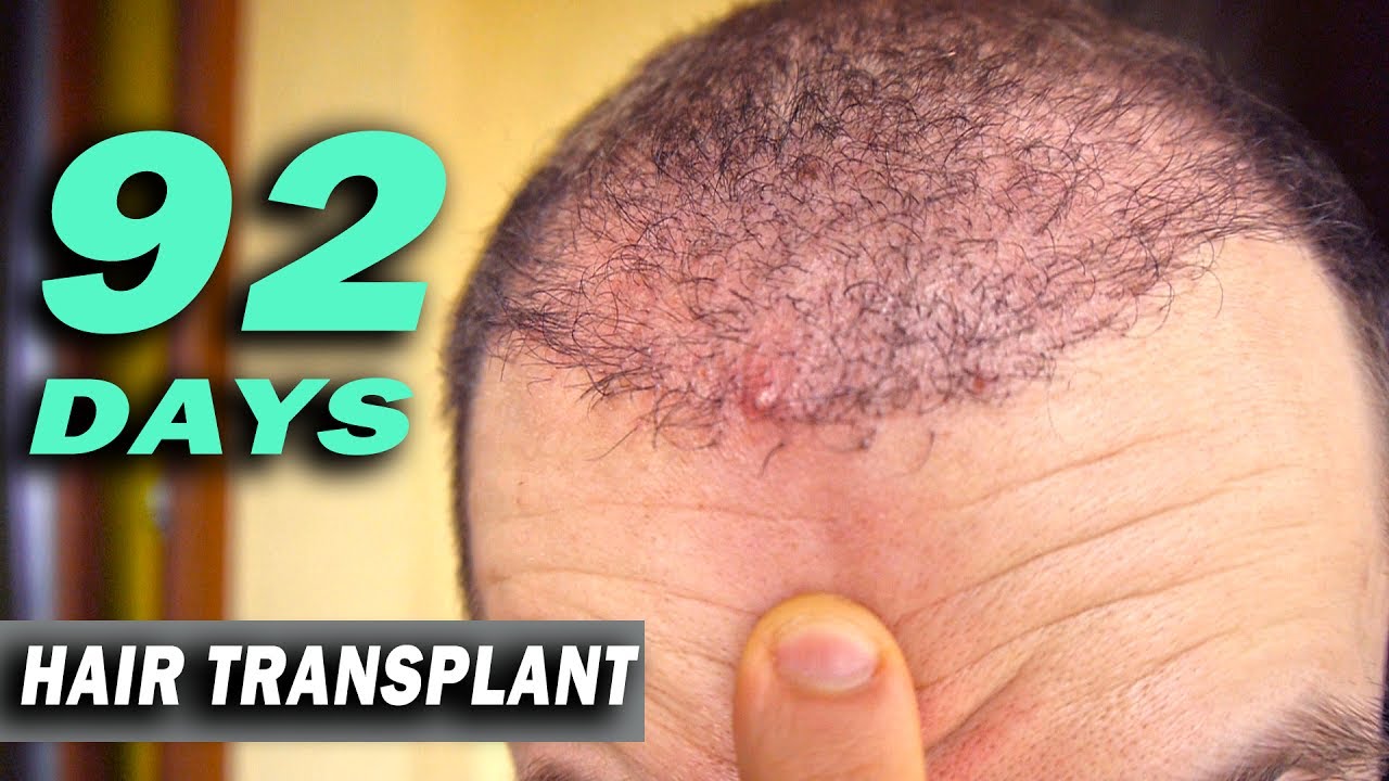 FUE Hair Transplant day 92 (post op) Istanbul, Turkey GROWTH STAGE