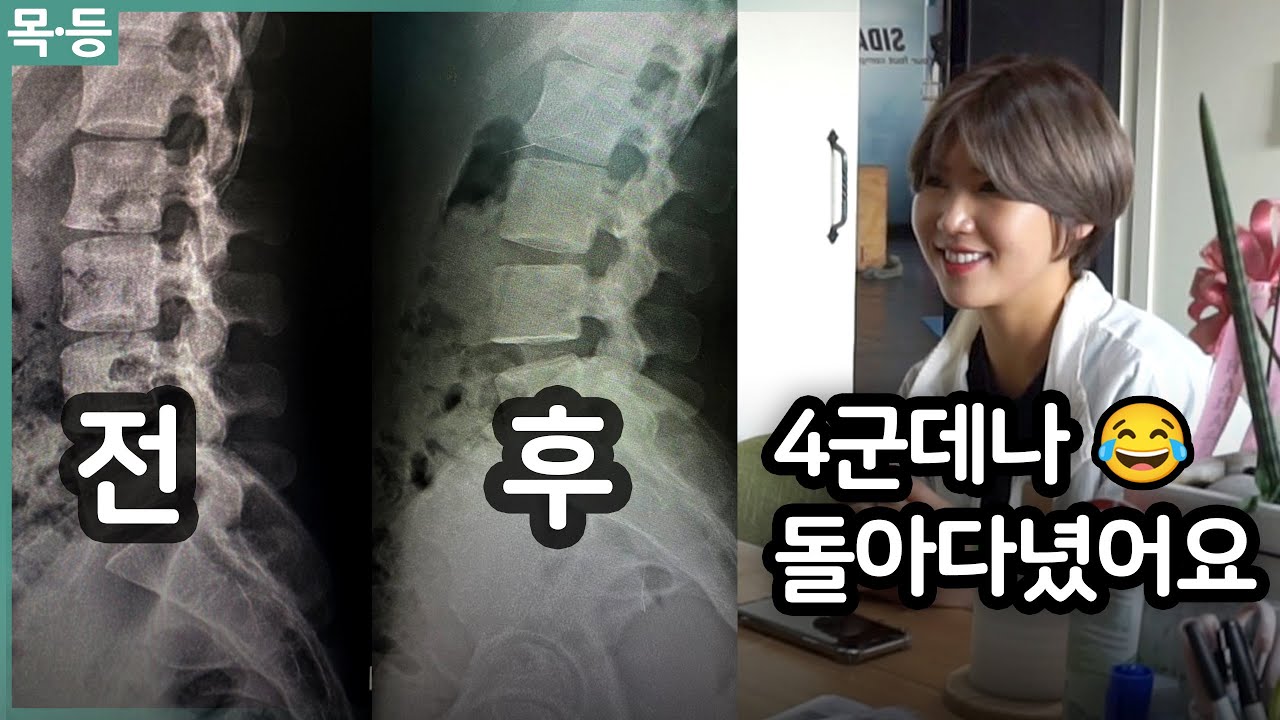 역C자목에 일자허리… 4군데나 돌아다녔어요😢 ~ 리얼재활다큐