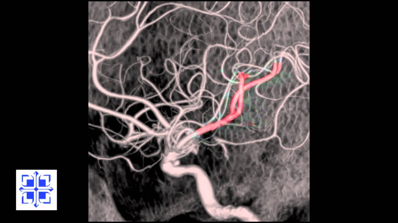 Interventional Stroke Rounds - Stroke Reversal with Penumbra