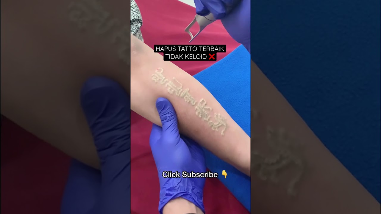Hapus Tatto Terbaik Tidak Bikin Keloid | Laser Tatto Removal #lasertattooremoval