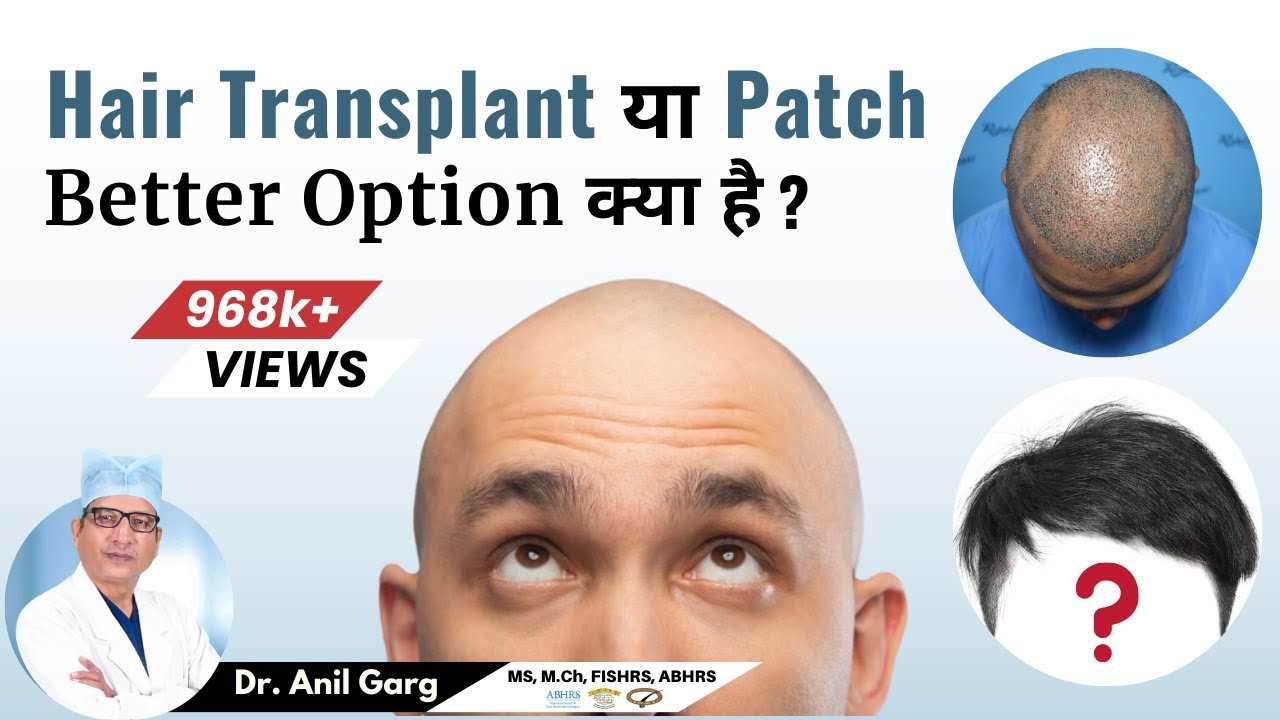 Hair Transplant or Patch  -  Which Is Better And Why? India - Dr. Anil Garg