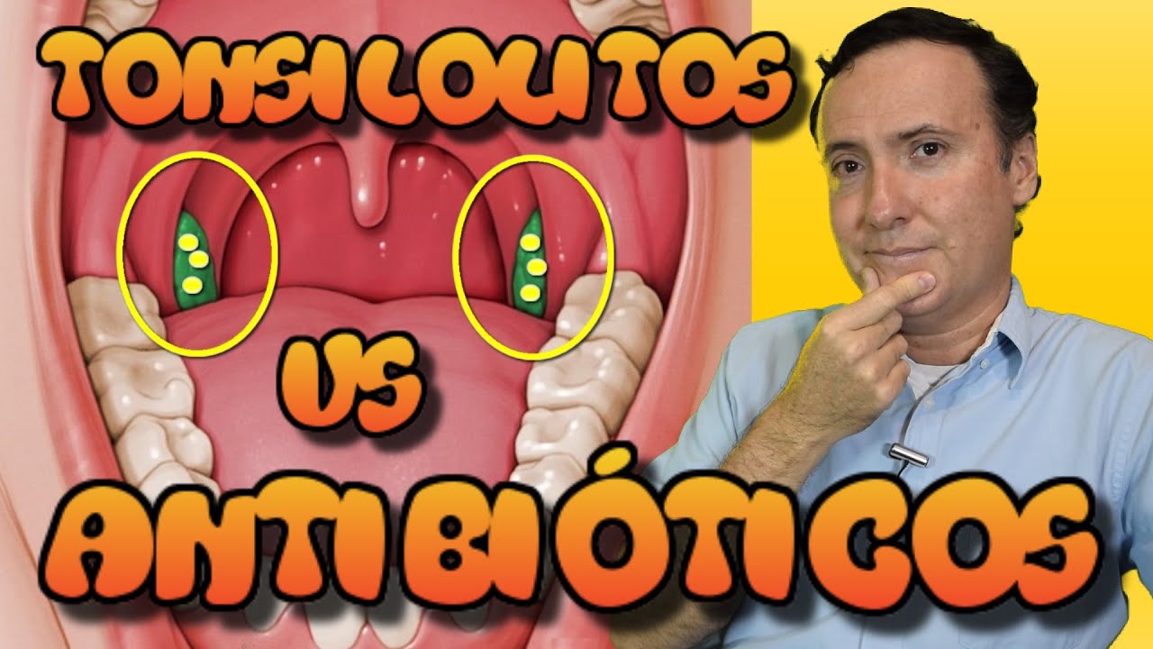Tonsilolitos vs antibióticos