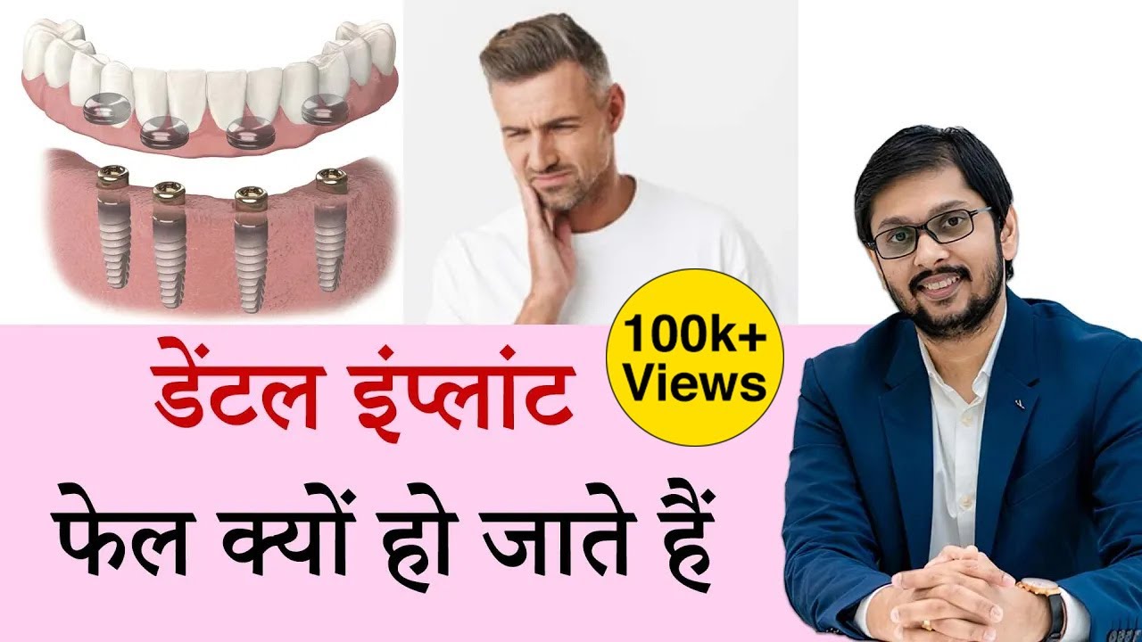 डेंटल इंप्लांट फेल क्यों हो जाते हैं? Success rate of Dental Implant by Dr Ankit Khasgiwala ,Indore