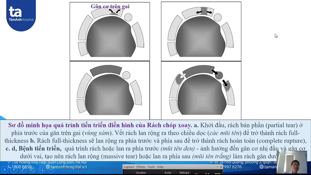 Si&ecirc;u &acirc;m khớp vai (BS Nguyễn Quang Trọng)