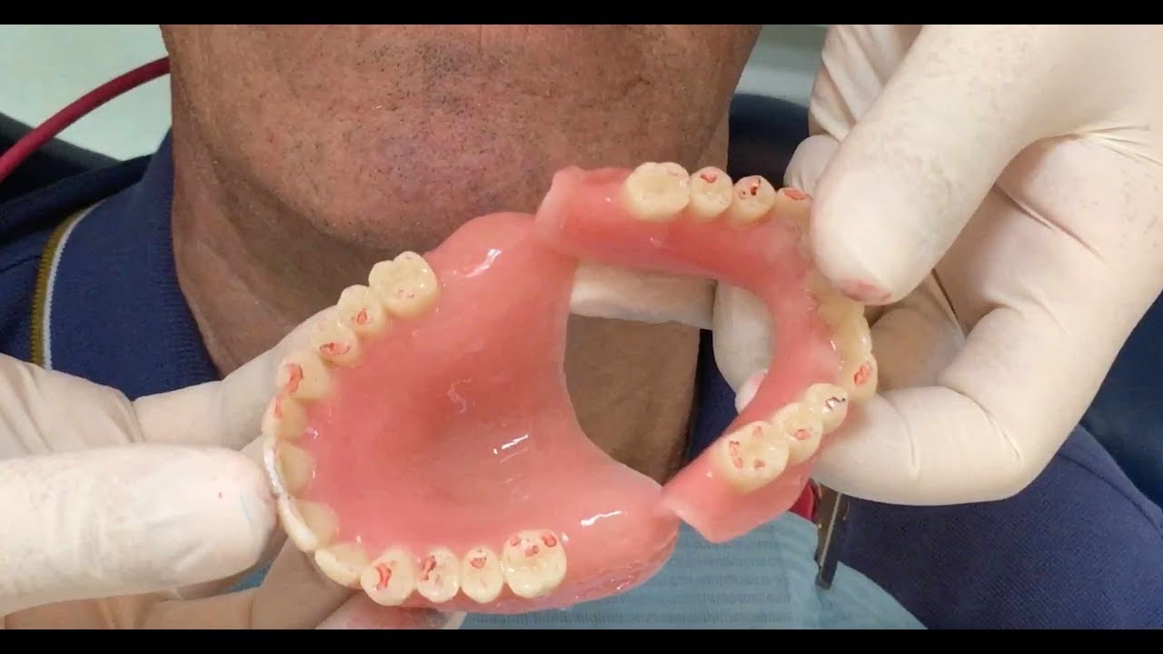 Removable complete and hybrid denture: fully digital