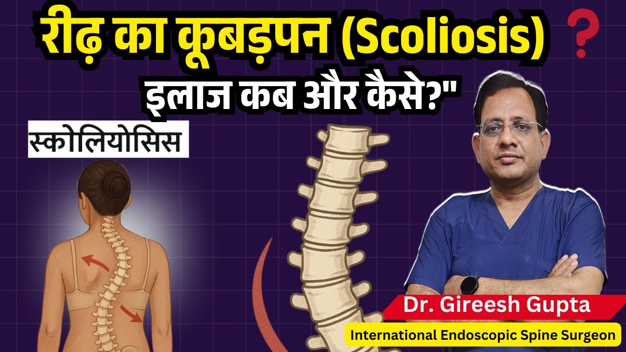 Scoliosis (रीढ़ की हड्डी का कूबड़पन) का इलाज | सही उम्र और सम्पूर्ण जानकारी | Dr. Gireesh Gupta